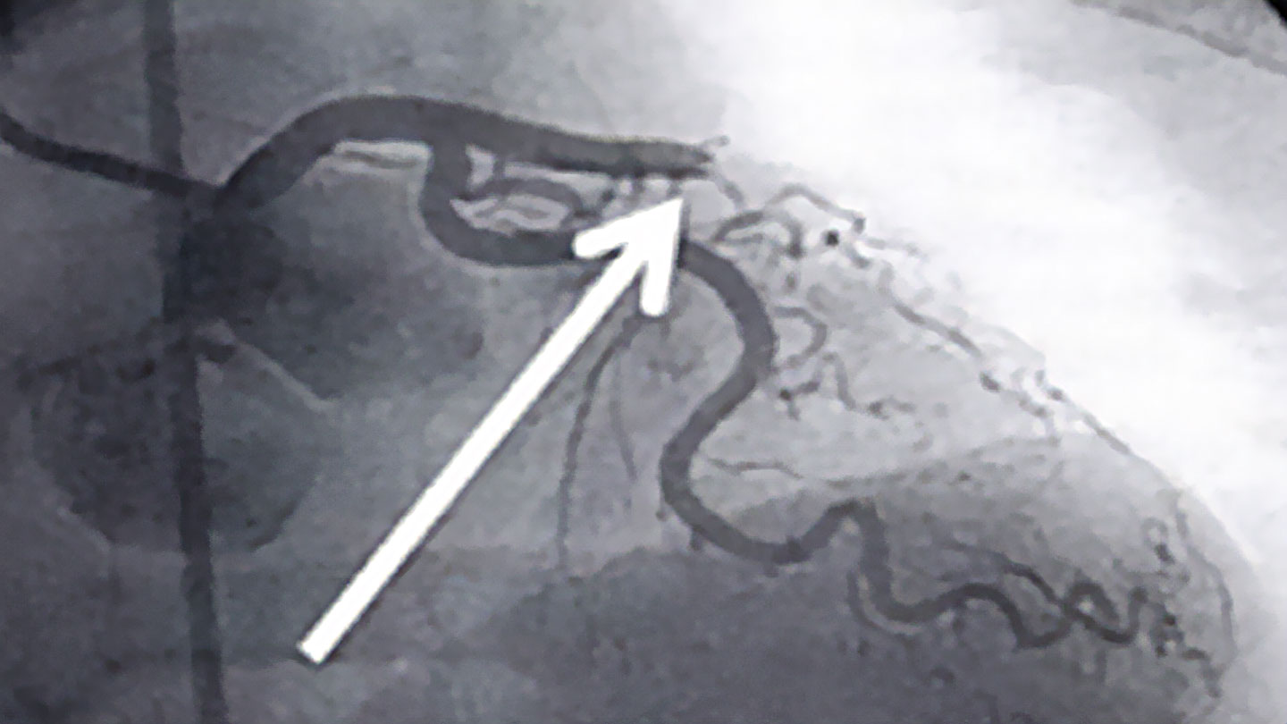 Wie wird ein Herzinfarkt therapiert?