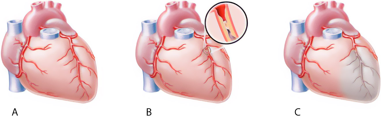 Koronare Herzerkrankungen